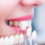 5 варіантів відновлення зубів