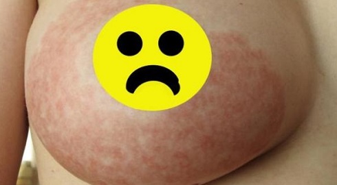 Растяжки на груди удалить Растяжки на груди удалить