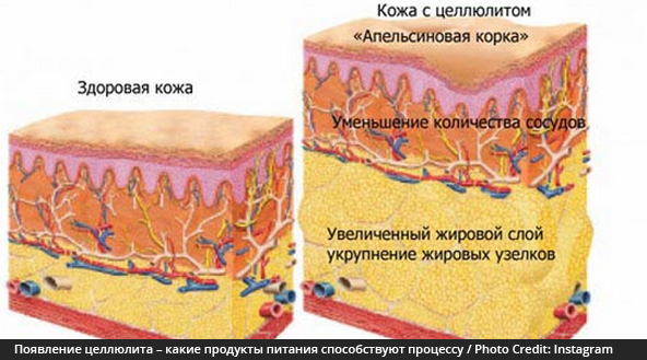 Поява целюліту - що сприяють процесу