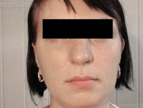 Устранение бокового смещения спинки носа