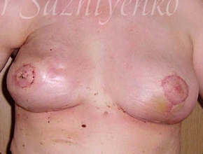 Правосторонняя коже-сохраняющая мастэктомия с одномоментным восстановлением груди