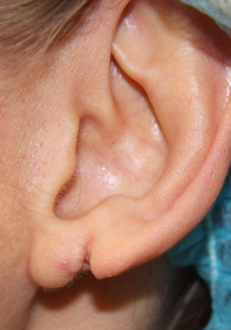 Корекція мочки вуха