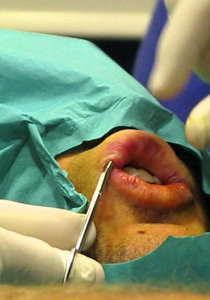 Увеличение губ (хирургическое)