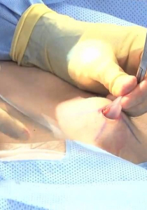 Переустановка имплантов или удаление имплантов (обе груди без стоимости имплантов)