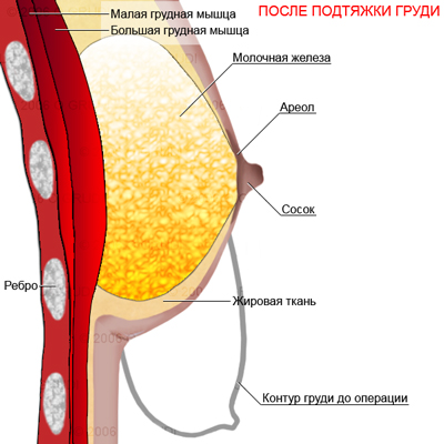 Подтяжка груди