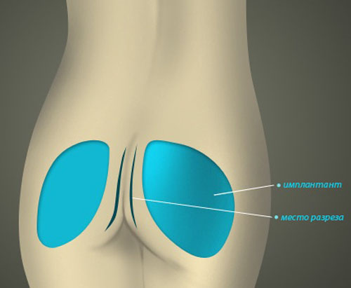 Операция по увеличению ягодиц