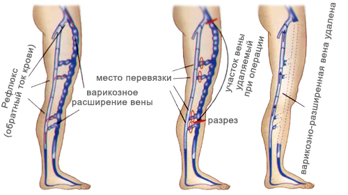 Флебэктомия