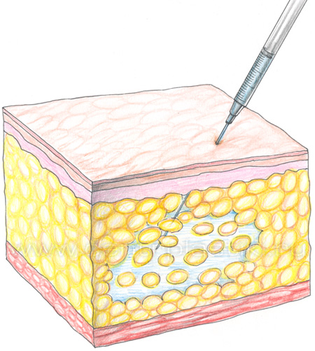 Липосакция инъекционная