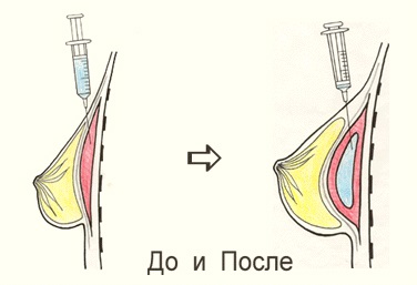 Липофилинг груди