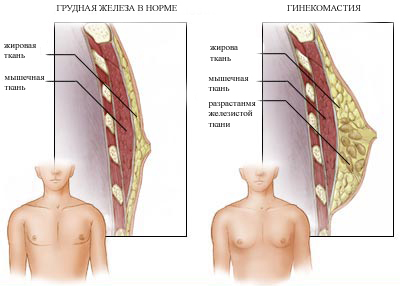 Гинекомастия