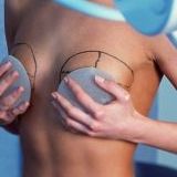 Четыре факта, которые нужно знать об увеличении груди и сосков