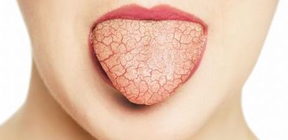 Что делать, если вы страдаете от сухости во рту (ксеростомия)