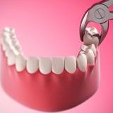Что такое зубы мудрости и зачем их удалять?