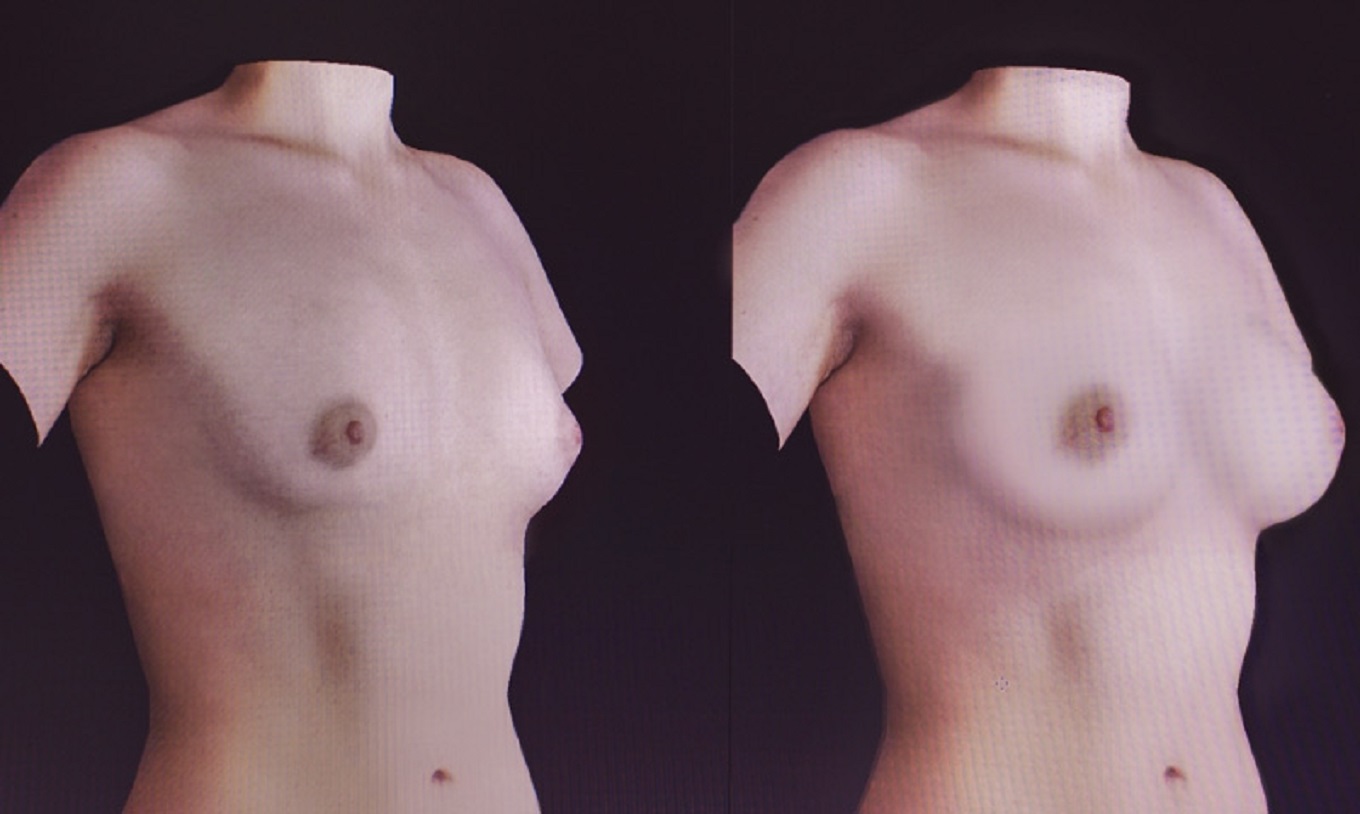асимметрия груди у мужчин фото 72