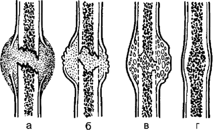 Периостальная костная мозоль. Этапы формирования костной мозоли. Сращение перелома костная мозоль. Этапы срастания кости при переломе.