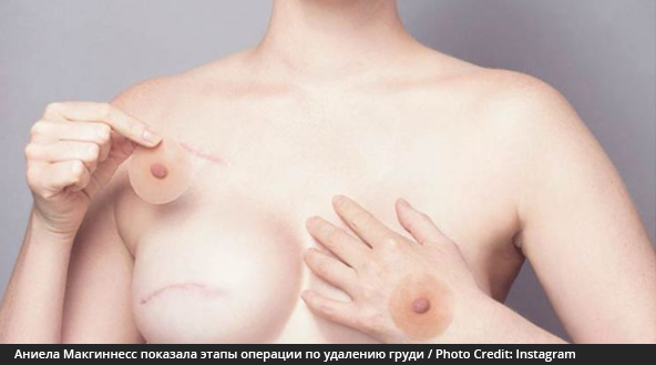 Аниела Макгиннесс показала этапы операции по удалению груди