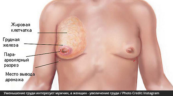 Уменьшение груди интересует мужчин, а женщинам более свойственно увеличение груди