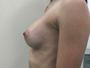увеличение груди