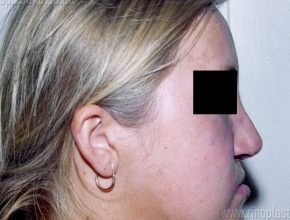 Исправление врожденной деформации носа