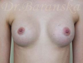 Увеличение груди анатомическими имплантами 255мл