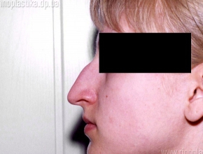 Исправление горбинки носа